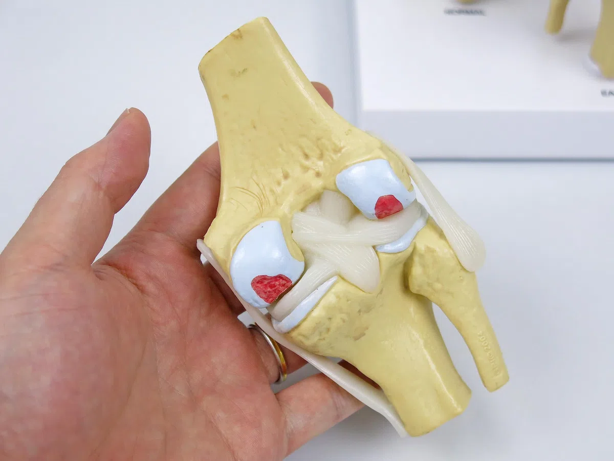 GPI Anatomicals 1100 Osteo-Kniemodellset 4 verschiedener Stadien